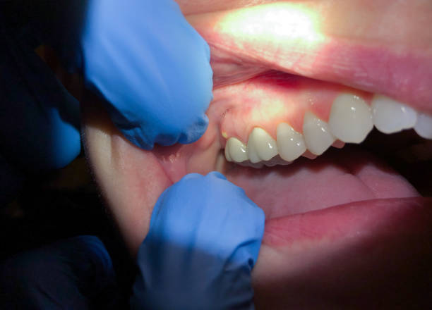 Best Emergency Wisdom Teeth Removal in Tremont, IL